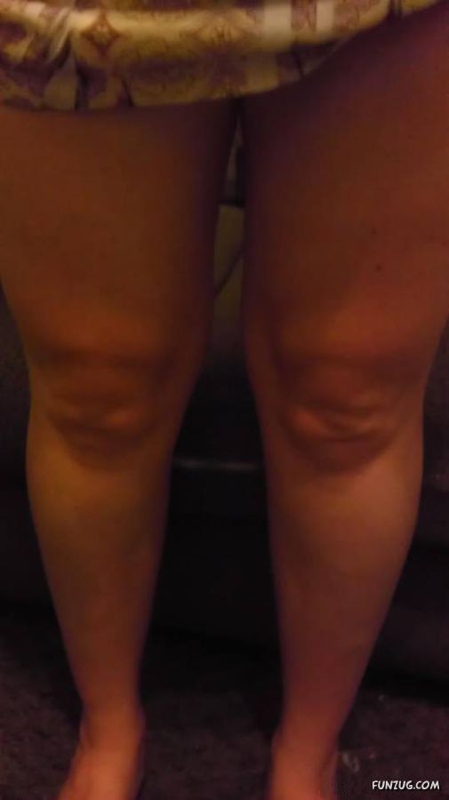 Knees That Look Like Faces