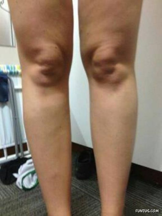 Knees That Look Like Faces